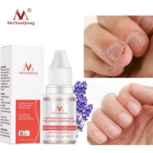 Nail Fungal Treatment Feet Care Serum Essence Nail Foot Whitening Toe Removal Gel Anti Infection Paronychia Onychomycosis 10ml