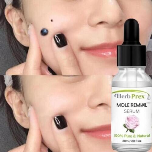 20ml Liquid Wart Mole Removal Serum Organic Tags Solutions Serum Skin Tag Mole Freckle Spot Fast Remover Painless Essence Care
