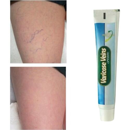 Chinese Varicose Veins Cream Ointment Vasculitis Treatment Vessel Blood Legs Inflammation Ointment Angiitis Phlebitis K6H2