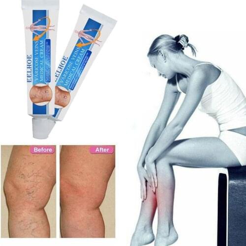 1Pcs 16g Varicose Veins Treatment Cream Varicosity Angiitis Remedy Ointment Relief Veins Pain Phlebitis legs Varicose Veins Crea