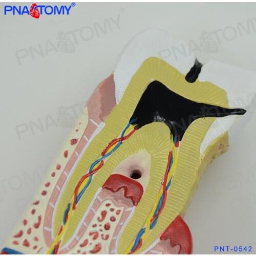 Enlarged Human Teeth Care Model Tooth Decay Dental Caries Medical Supplies Teaching Resources Anatomical Model Dental Model