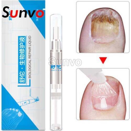 Fungal Nail Treatment Essence Treatment Herb Nails Repair Cream Onychomycosis Paronychia Anti Fungal Nail Care Shoe accessories