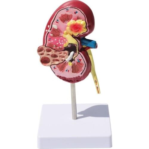 Human kidney Anatomical model Pathological kidney model Anatomical model of human internal organs