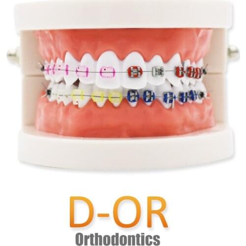 Dental Teeth Model,Transparent Dental Implant Teeth Model Dentist Standard Disease Removable Tooth Pathological Teaching Model