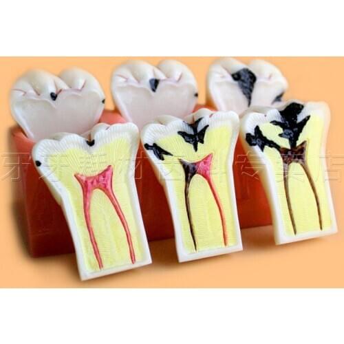 High Quality Caries jewelry decomposition model of teaching evolution model Dental Teaching Study Model
