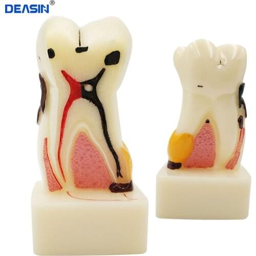 Dental Teeth Model 4 Times periodontal disease model pathology tooth model