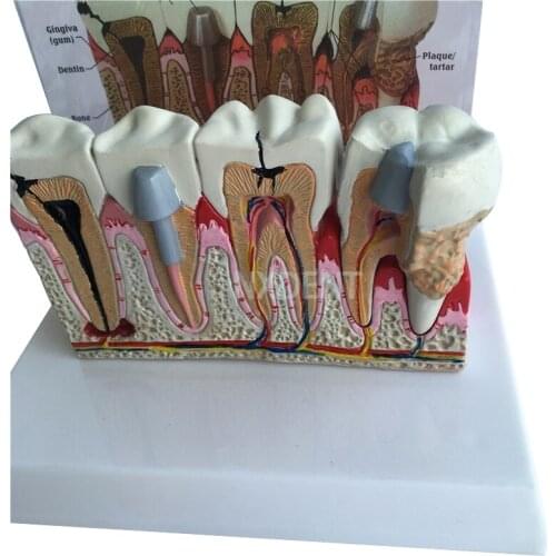 1pcs Dental Anatomical Tooth Teeth Model Anatomy Teeth Model Oversized Anatomy Decayed Tooth Demonstration Communication