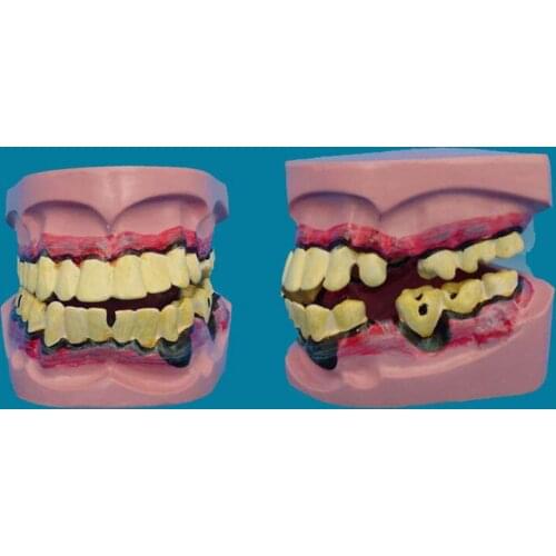 Dental Implant Disease Teeth Model Smoking Decay Caries Tooth Model Denture for Dentist Medical Science Teaching Tooth Anatomy