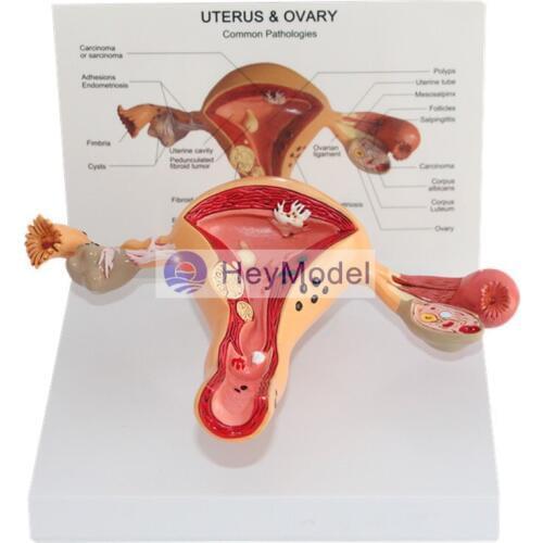 HeyModel Female Uterine ovary uterine pathology model
