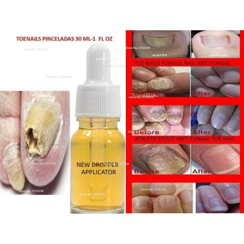 ANTI FUNGAL TREATMENT EXTRA STRENGTH TOENAIL FUNGUS FUNGI XS NAIL ATHLETES FOOT