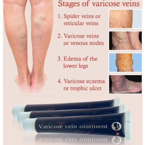 Varicose Veins Treatment Cream Effective Cure Vasculitis Phlebitis Spider Veins Pain Varicosity Angiitis Ointment Health Care