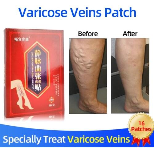 8Patches Spider Legs Veins Varicose Treatment Paste Varicose Veins Cure Plaster Natural Herbal Medically Care Health Product