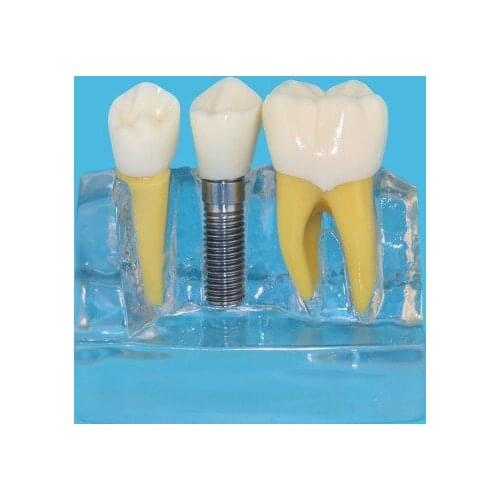 Implanted teeth Demo Model Dentist doctor Patient communication free shipping