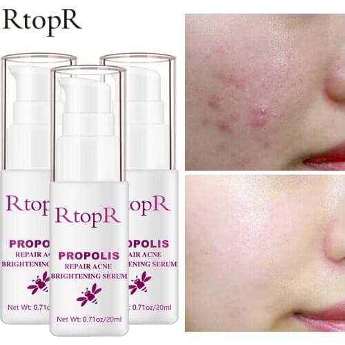 5pc RtopR Acne Brightening Essence Acne Scar Repair Moisturizing Serum Shrinkage Elimination Acne Treatment Propolis Oil Control