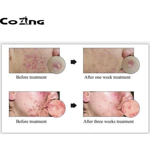 105W Medical grade LED Light Photodynamic Skin Care Rejuvenation Photon Facial Body Therapy