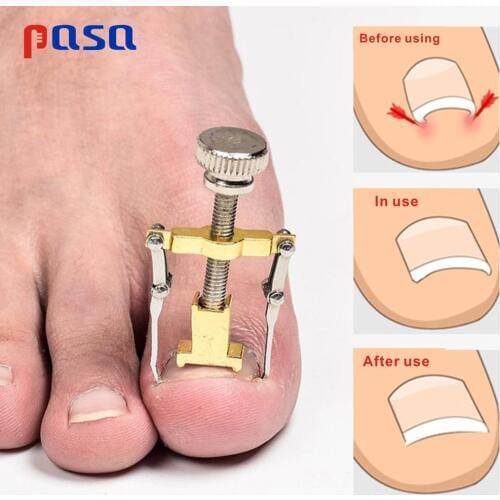Hot Sale Ingrown toenails pedicure foot nail care tools file for feet orthotic acronyx ingrowing nail onyxis corrector for toes
