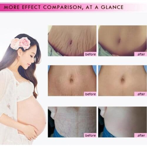1PC New Mango Remove Pregnancy Acne Scar Stretch Mark Cream Treatment Maternal Anti-Aging Repair Anti-Wrinkle Firming Body Cream