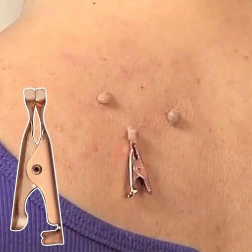 5pcs/Set Skin Tags Remover Wart Tattoo Clip Blackhead Tools Tags Beauty Makeup Removers Skin Blemish Out Coppers L3C6