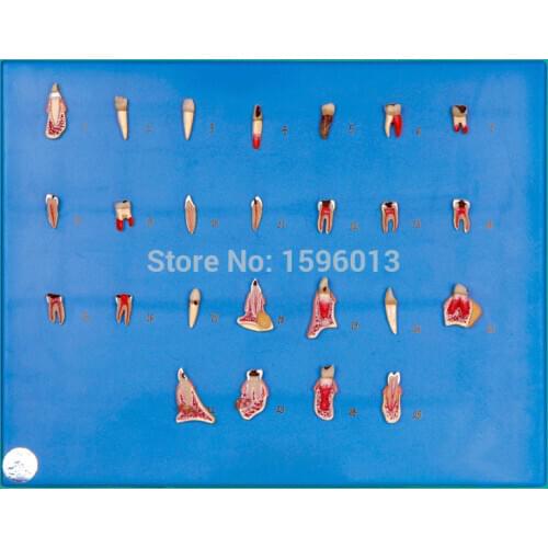 Dental Diseases Model, Dental pathology series model, teeth disease model