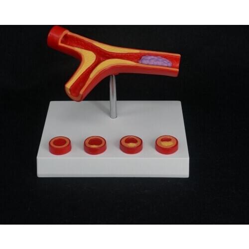 Human Arterial Atherosclerosis Arteriosclerosis Model Thrombus Vascular Medical Model