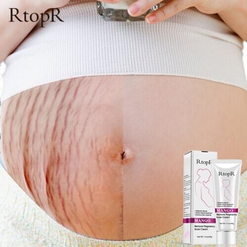 2Pcs Mango Remove Pregnancy Scars Acne Cream Stretch Marks Treatment Maternity Repair Anti-Aging Anti-Winkles Firming Body Cream