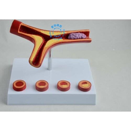 Free shipping&Imported technology, arterial stiffness model (with thrombus), coronary vessel anatomic surface model