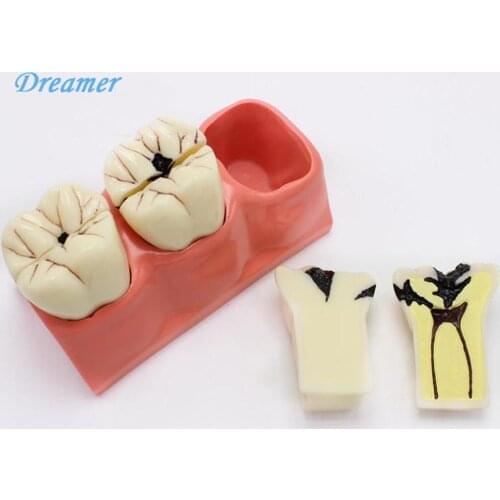 Dissected Model of Dental Caries,Caries Decomposition Model Oral Dental Tooth Model Teeth Whitening