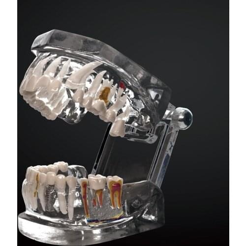 New Transparent Disease Teeth Model Dental Implant Teeth Model Dentist Dental Student Learning, Teaching, Research Communication