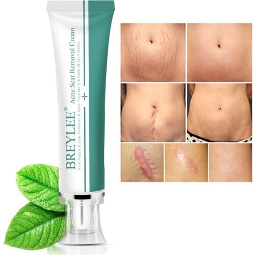 Lanbena Removal Scar Cream Face Pimples Scar Stretch Marks Removal Acne Treatment Whitening Moisturizing Cream Skin Care 30g