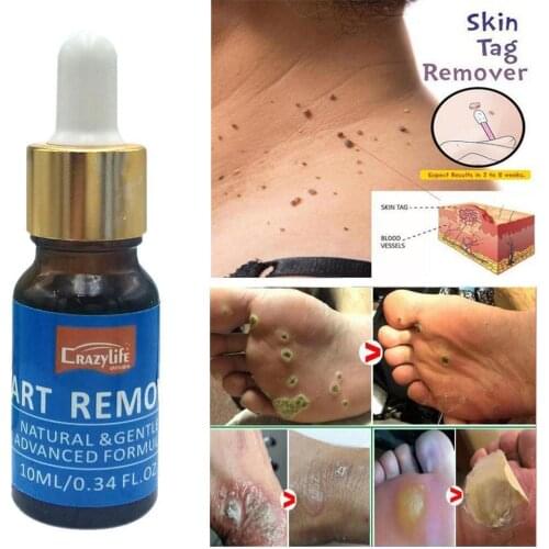 1PC 10ML Body Wart Treatment Papillomas Removal of From Remover Warts Remedy Anti Tags Moles Removing Liquid Skin Verruca W5L9