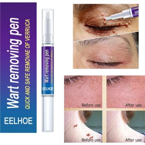 Skin Tag Remover Wart Removal Plaster Herbal Plaster Warts Ointment Warts Remover Antibacterial Ointment Wart Treatment Cream