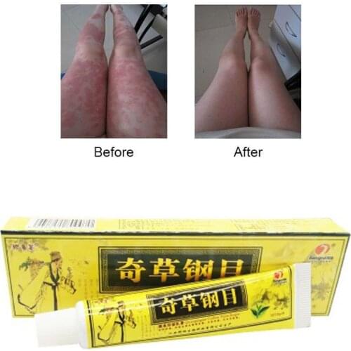 1pc Skin Psoriasis Cream Dermatitis Eczematoid Eczema Ointment Treatment Psoriasis Cream Skin Care Cream medical plaster