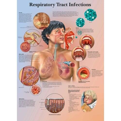 Respiratory Tract Infections Picture Art print Silk poster Home Wall Decor