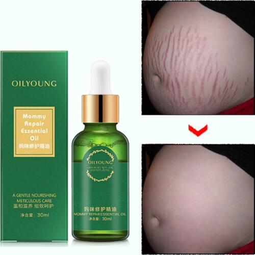Stretch Marks Remover Essential Oil Skin Care Treatment Cream For Stretch Mark Removal Maternity Slackline For Pregnant Oils