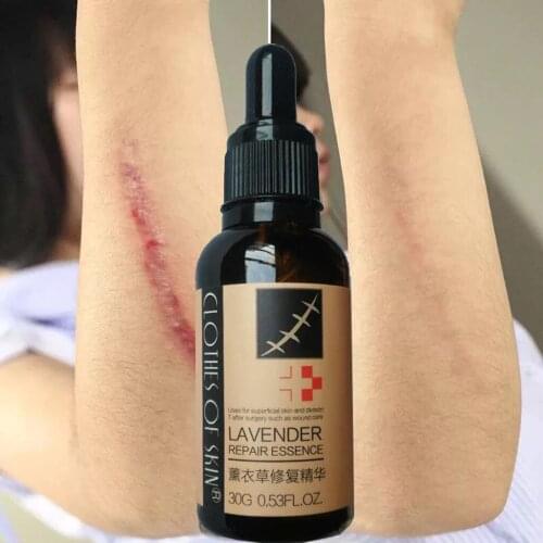 Go Scar Removal Gel For Keloids, Burn, Sports Injuries Scar Acne 30g Lavender Repair Essence