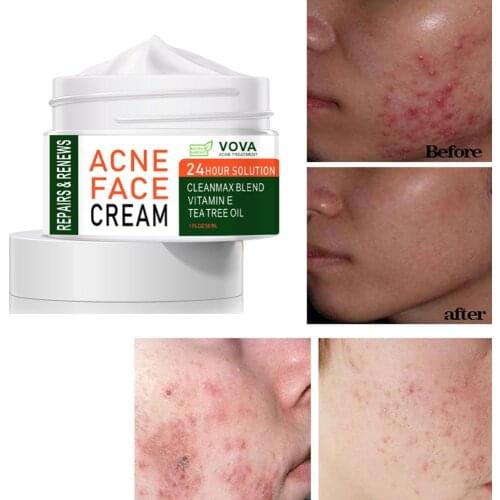 VOVA Effective Acne Removal Cream Acne Treatment Fade Acne Spots Oil Control Whitening Moisturizing Tea Tree Oil Acne Cream