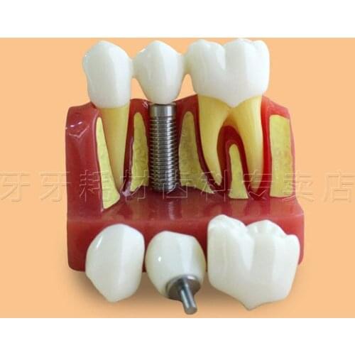 High Quality Four Times The Magnification Transparent Dental Implant Model,Tooth Model,Dental Implant Practice Model