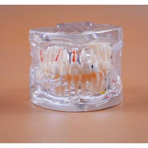 C4 Teeth Model High Quality Pathology Model with Implant for Hospital and School Dental Study Model
