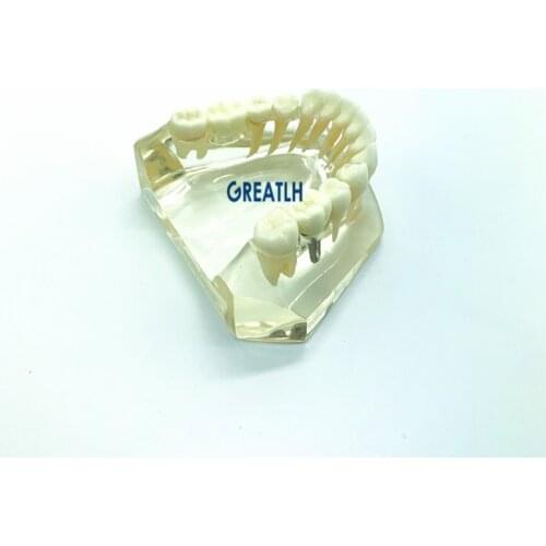 Dental Lower Jaw teeth Implant Dental implant fixtures Bridge Model Typodont dental school learing study model