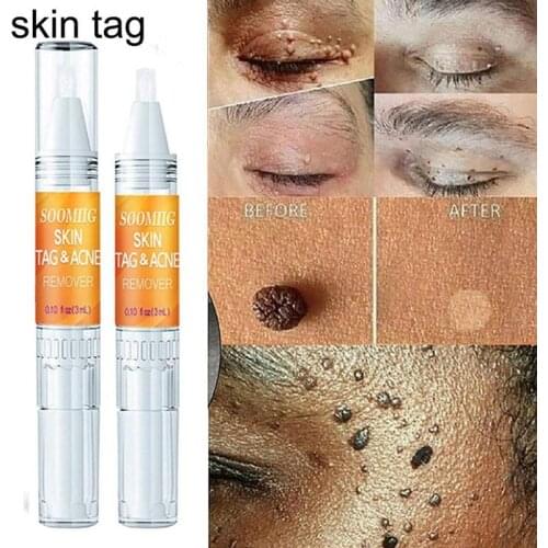 2021 New Face Remover Genital Skin Wart Treatment Removal Papillomas & Mole Foot Corn M3R7