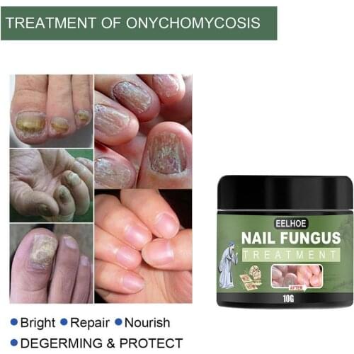 Feet Care Fungal Nail Treatment Onychomycosis Antibacterial Nail Essence Fungus Nail Cream Repair Removal Cream Infection A Y7D5