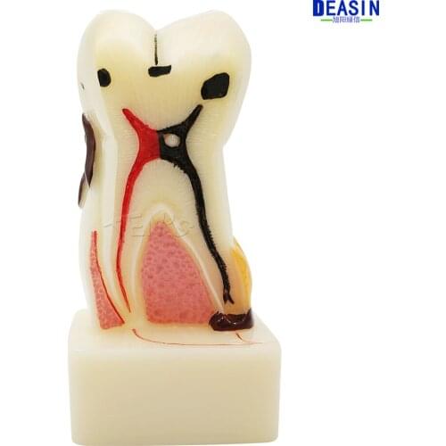 2016 New Four times size dental pathology teeth model, dental caries, calculus, pulp stones, Occlusal tooth wear