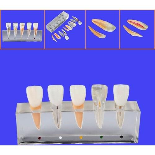 1 Piece Dental Teeth Model Decomposable for Pulp Treatment Pathology Series and Doctor-Patient Communication