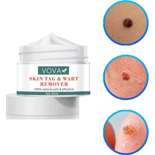 Remove Warts Cream Antibacterial Wart Treatment Remove SkinTag Papillomas Anti Foot Corn Warts Herbal Extract Skin Care