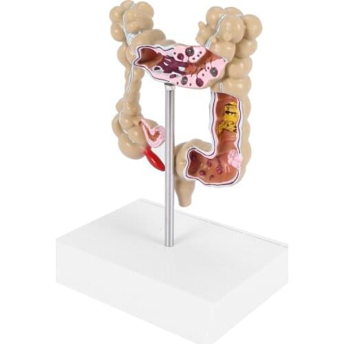 Colorectal Lesion Model Human Colon Large Intestine Pathological Diseases Model Mrganizer Anatomy