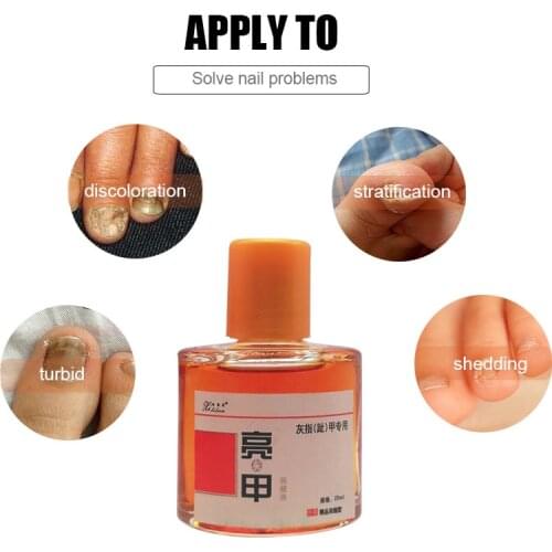 Fingernails Toenail CareNail Repair Serum Essences OnychomycosisTreatment Anti-infective Foot Nail Fungus Removal Gel Paronychia