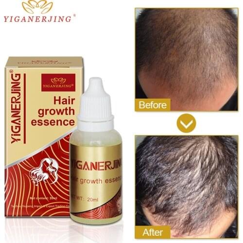 10pcs Original YIGANERJING 20ML Hair Growth Product Natural Pure Essential Oil for Fast Hair Growth Healthy Dense Dropshipping