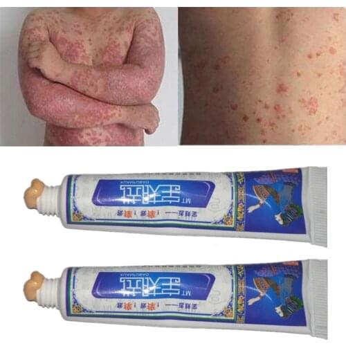 Herbal Skin Care Cream Psoriasis Ointment Cream Dermatitis Eczema Pruritus Cream Skin Repair Body Creams Patch Ploysmbety
