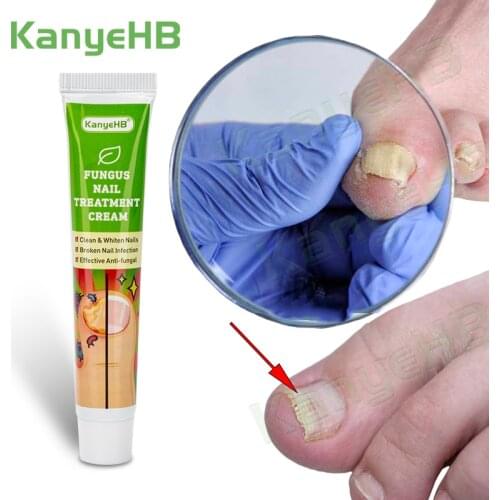 1pcs Nail Fungal Treatment Cream Feet Nail Care Cream Toe Nail Whitening Fungus Paronychia Onychomycosis Removal Ointment G004
