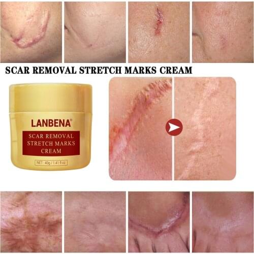40g Scar Removal Cream Repair Acne mark Scar Treatment Blackhead Spots Stretch MarksWhitening Skin Care Cream